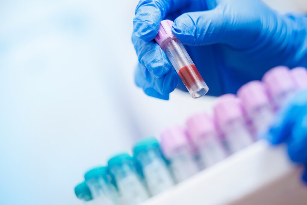 Scientists Create First Accurate Blood Test for Chronic Fatigue Syndrome